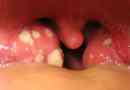 Cauze și simptome ale stafilococului în gură