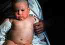 Simptome și tratamentul toxoplasmozei congenitale și dobândite la copii, prognostic