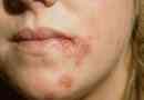 Simptomele stafilococului auriu pe piele
