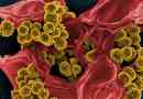 Staphylococcus aureus: tipuri, diagnostic, tratament la adulți
